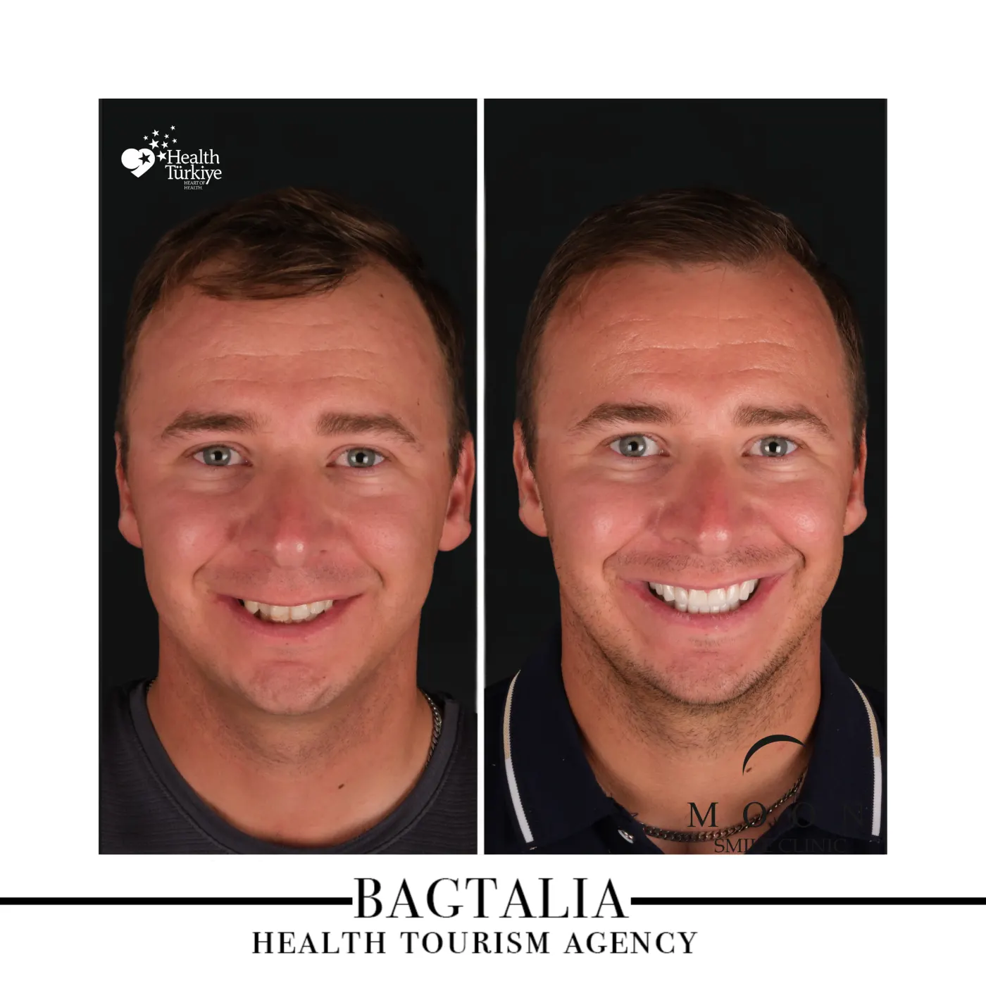 Moon Smile Clinic dental treatment result