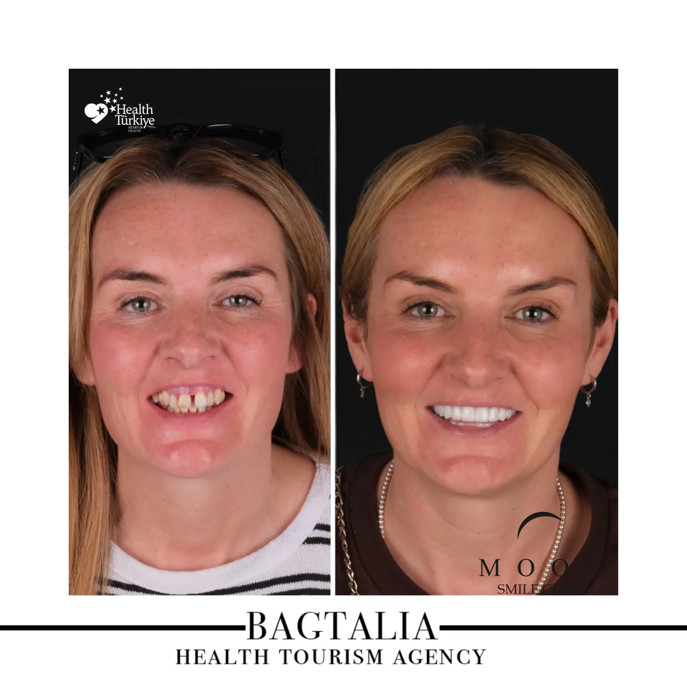 Moon Smile Clinic dental treatment result