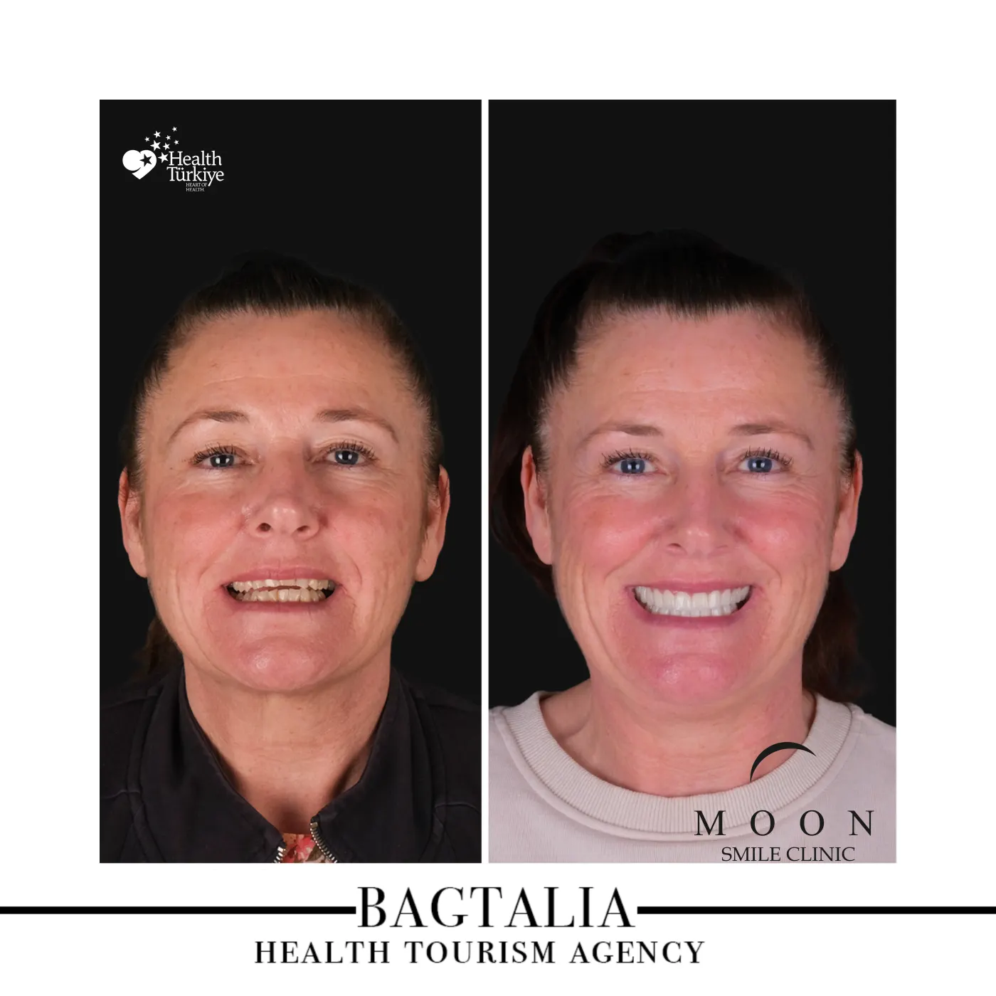 Moon Smile Clinic dental treatment result